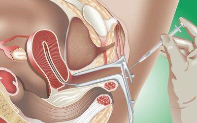 درمان ناباروری با IUI در اصفهان | بهترین دکتر برای ای یو ای در اصفهان