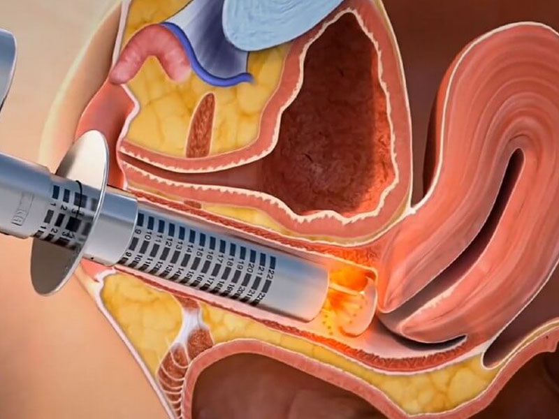 لیزر مونالیزا در اصفهان