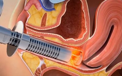 بهترین لیزر مونالیزا