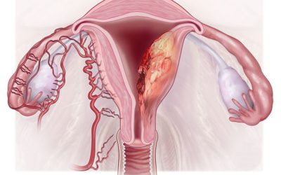 سرطان رحم کشنده است؟