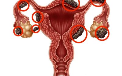 آندومتریوز و بارداری