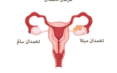 سرطان تخمدان چیست؟