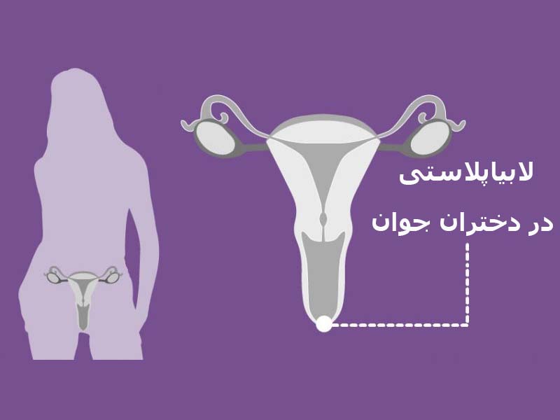 لابیاپلاستی در دختران جوان