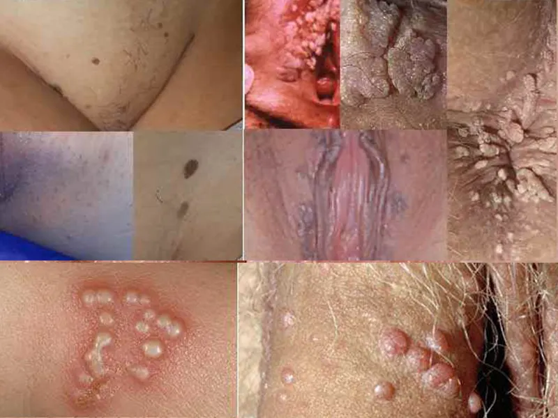 انواع زگیل تناسلی