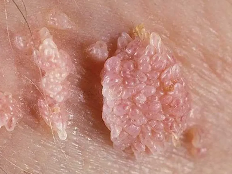 علائم زگیل تناسلی