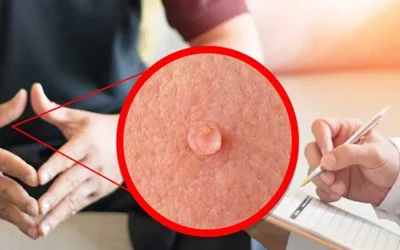 موثر ترین روش درمان زگیل تناسلی