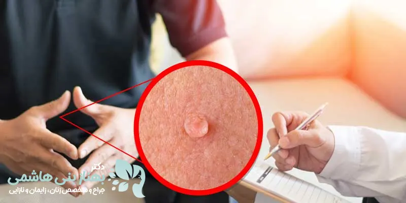 شایع ترین راه انتقال بیماری زگیل تناسلی از طریق روابط جنسی می باشد. در واقع زگیل تناسلی یکی از بیماری های منتقله جنسی یا (STD)می باشد اما الزاما این بیماری از طریق رابطه جنسی منتقل نمی شود. گاهی اوقات از طریق استفاده از لوازمی مانند تیغ یا لیف مشترک و یا رفتن به مکان هایی مانند سونا که به نوعی ویروس در آن پخش شده باشد می تواند منتقل شود. همچنین تماس پوستی فرد سالم با فردی که دارای زگیل تناسلی می باشد نیز می تواند یکی دیگر از راه های انتقال زگیل تناسلی باشد.