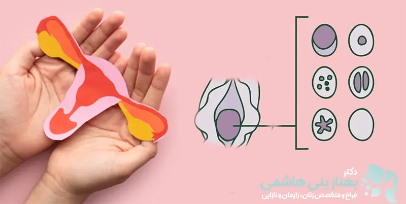 انواع پرده بکارت