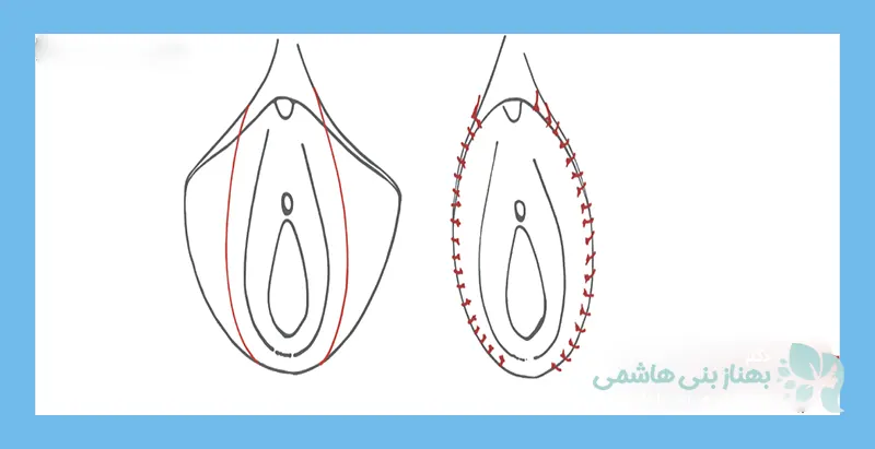 عکس بخیه لابیاپلاستی