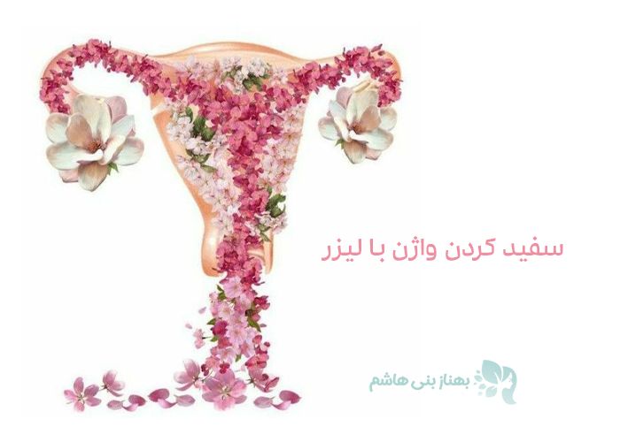 سفید کردن واژن با لیزر