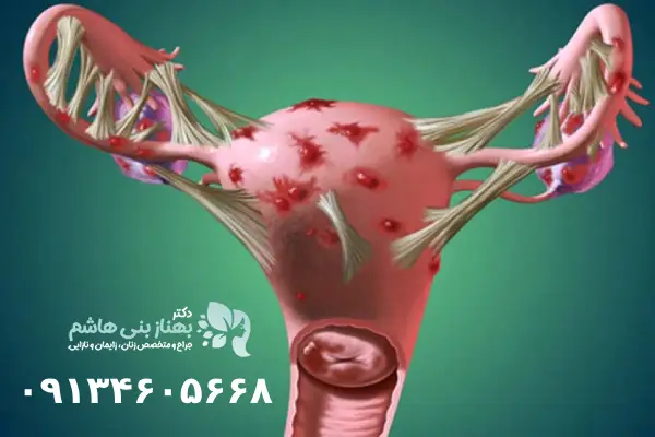 درمان کیست تخمدان